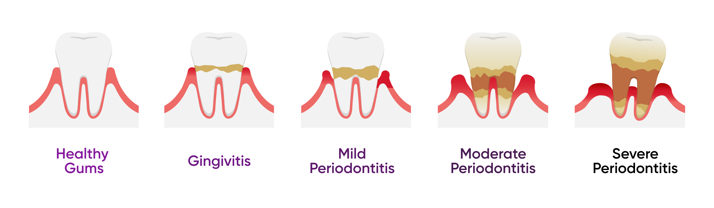 Diagram comparing healthy gums and periodontal disease