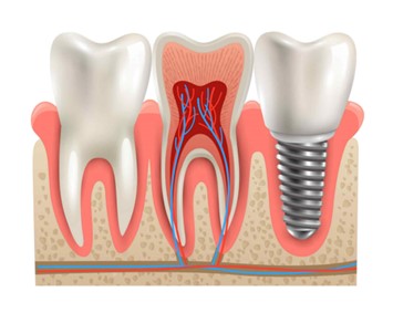 Diagram comparing healthy tooth and tooth with abscess