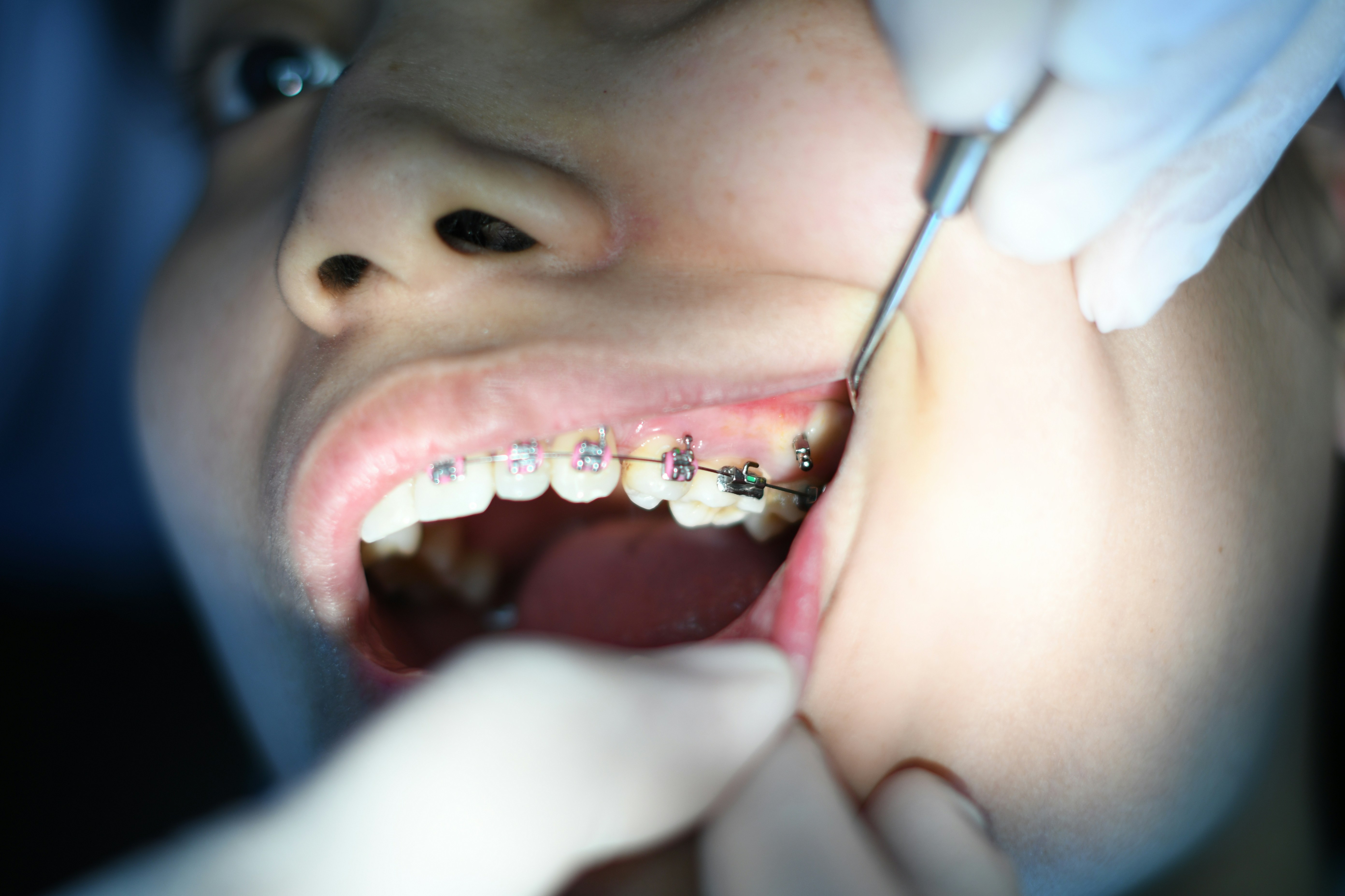 Periodontal treatment showing healthy gums